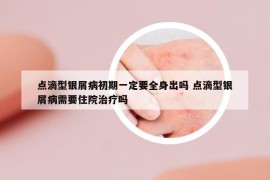 点滴型银屑病初期一定要全身出吗 点滴型银屑病需要住院治疗吗