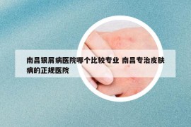 南昌银屑病医院哪个比较专业 南昌专治皮肤病的正规医院