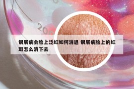 银屑病会脸上泛红如何消退 银屑病脸上的红斑怎么消下去