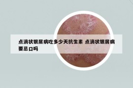 点滴状银屑病吃多少天抗生素 点滴状银屑病要忌口吗