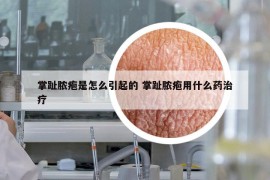 掌趾脓疱是怎么引起的 掌趾脓疱用什么药治疗