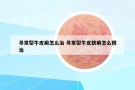 寻常型牛皮癣怎么治 寻常型牛皮肤癣怎么根治