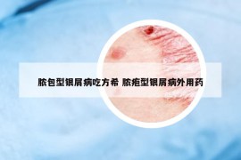 脓包型银屑病吃方希 脓疱型银屑病外用药