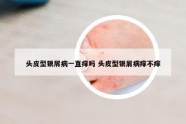 头皮型银屑病一直痒吗 头皮型银屑病痒不痒