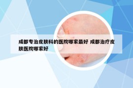 成都专治皮肤科的医院哪家最好 成都治疗皮肤医院哪家好