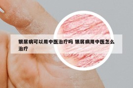 银屑病可以用中医治疗吗 银屑病用中医怎么治疗