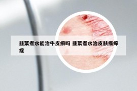 韭菜煮水能治牛皮癣吗 韭菜煮水治皮肤瘙痒症