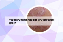 牛皮癣南宁哪家医院能治好 南宁银屑病医院哪里好