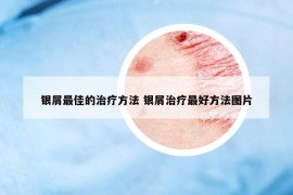 银屑最佳的治疗方法 银屑治疗最好方法图片