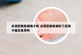 点滴型银屑病嗓子疼 点滴型银屑病好了后嗓子痛会复发吗