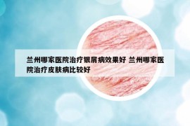 兰州哪家医院治疗银屑病效果好 兰州哪家医院治疗皮肤病比较好