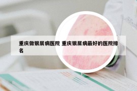 重庆做银屑病医院 重庆银屑病最好的医院排名