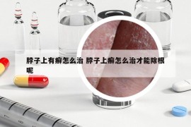 脖子上有癣怎么治 脖子上癣怎么治才能除根呢