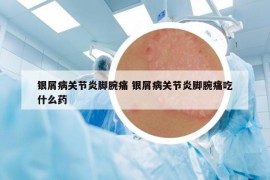 银屑病关节炎脚腕痛 银屑病关节炎脚腕痛吃什么药