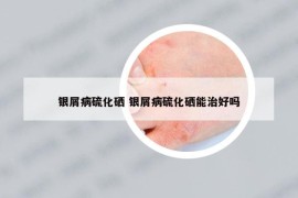 银屑病硫化硒 银屑病硫化硒能治好吗