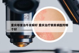 重庆哪里治牛皮癣好 重庆治疗银屑病医院哪个好