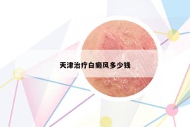 天津治疗白癜风多少钱