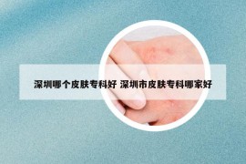 深圳哪个皮肤专科好 深圳市皮肤专科哪家好