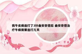 我牛皮癣连打了3针曲安奈德后 曲安奈德治疗牛癣需要连打几天