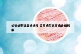 关节病型银屑病病程 关节病型银屑病诊断标准