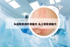 头部银屑病外用偏方 头上银屑病偏方