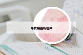 牛皮癣最新视频