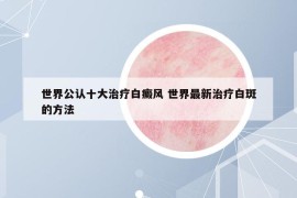 世界公认十大治疗白癜风 世界最新治疗白斑的方法