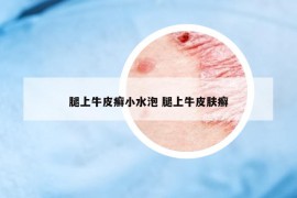 腿上牛皮癣小水泡 腿上牛皮肤癣