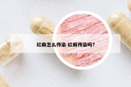 红癣怎么传染 红癣传染吗?