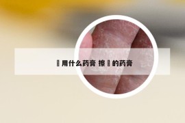 廯用什么药膏 擦廯的药膏