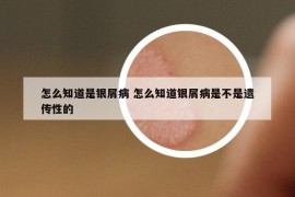 怎么知道是银屑病 怎么知道银屑病是不是遗传性的