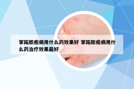 掌跖脓疱病用什么药效果好 掌跖脓疱病用什么药治疗效果最好