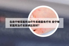 在南宁哪家医院治疗牛皮癣最有疗效 南宁哪家医院治疗皮肤病比较好?