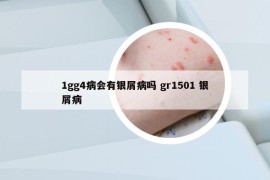 1gg4病会有银屑病吗 gr1501 银屑病