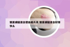 银屑病输液会使血糖升高 银屑病输液会好得快么