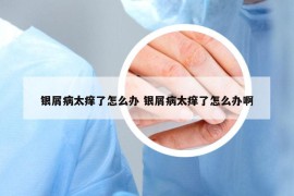 银屑病太痒了怎么办 银屑病太痒了怎么办啊