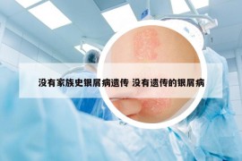 没有家族史银屑病遗传 没有遗传的银屑病