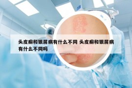 头皮癣和银屑病有什么不同 头皮癣和银屑病有什么不同吗