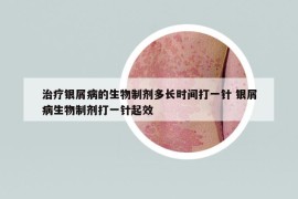 治疗银屑病的生物制剂多长时间打一针 银屑病生物制剂打一针起效