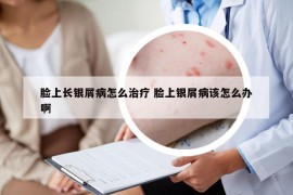 脸上长银屑病怎么治疗 脸上银屑病该怎么办啊