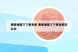 银屑病留下了很多疤 银屑病留下了很多疤怎么办