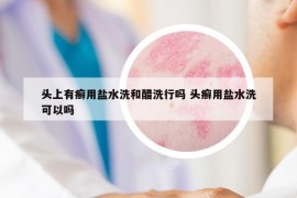 头上有癣用盐水洗和醋洗行吗 头癣用盐水洗可以吗