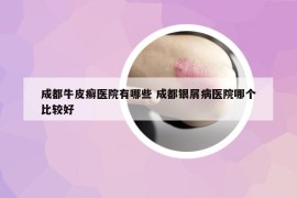 成都牛皮癣医院有哪些 成都银屑病医院哪个比较好