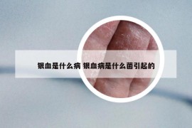 银血是什么病 银血病是什么菌引起的