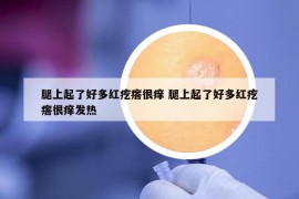 腿上起了好多红疙瘩很痒 腿上起了好多红疙瘩很痒发热