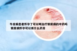 牛皮癣患者怀孕了可以喝治疗银屑病的中药吗 银屑病怀孕可以用什么药膏