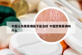 中医认为银屑病能不能治好 中医把银屑病叫什么