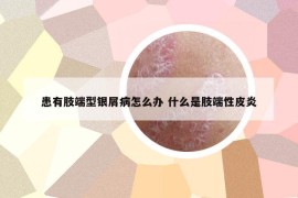 患有肢端型银屑病怎么办 什么是肢端性皮炎