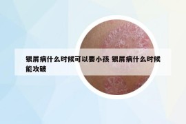 银屑病什么时候可以要小孩 银屑病什么时候能攻破