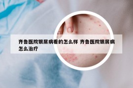 齐鲁医院银屑病看的怎么样 齐鲁医院银屑病怎么治疗